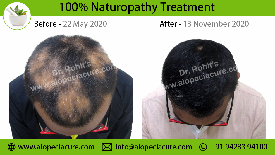 Alopecia Areata Result 2